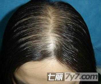 脱发是因为什么原因（掉发的原因及治疗该怎么做）