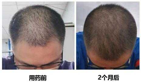 雄性激素高脱发怎么治疗,雄性激素脱发怎么治疗最好