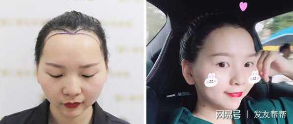 美人尖怎么（怎么把美人尖去掉）