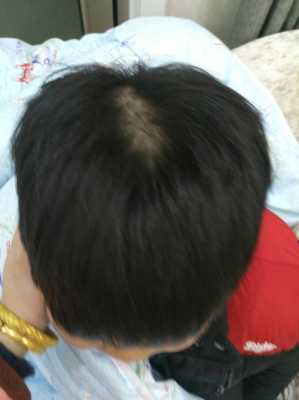 我小孩今年1岁半了，怎么头发特别稀少，特别是头顶上面，怎么办,头发少是因为什么原因