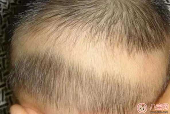 我小孩今年1岁半了，怎么头发特别稀少，特别是头顶上面，怎么办,头发少是因为什么原因