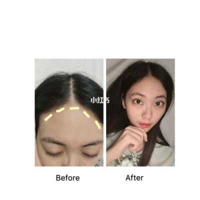 发际低怎么办（发际线低怎么处理）