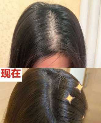 头发干枯脱发怎么回事（头发干枯脱发怎么回事儿）