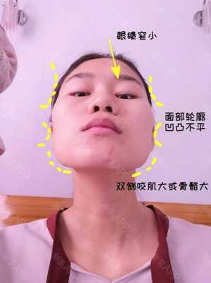 脸很扁平怎么办,扁脸是怎么造成的