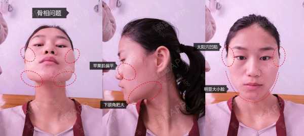 脸很扁平怎么办,扁脸是怎么造成的