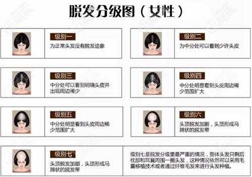 怎么判断脱发类型（怎么判断脱发类型女性）