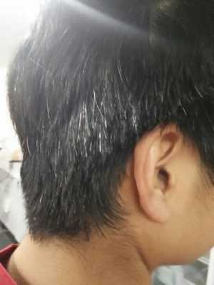 少白发怎么办（我有少白头有点自卑，好找对象吗）