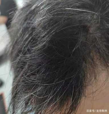 少白发怎么办（我有少白头有点自卑，好找对象吗）