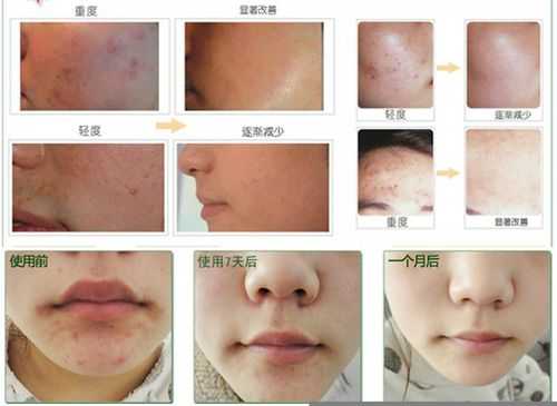 粉刺痘痘怎么去除（粉刺痘痘怎么去除小妙招）