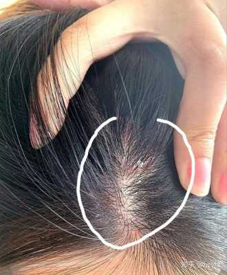 头部痒是怎么回事,最近头皮痒怎么回事女性