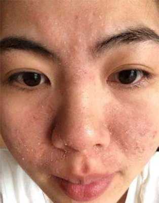 脸上皮肤很干怎么办（冬天脸上皮肤很干怎么办）