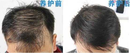 为什么男人老了头顶会秃,男人为什么会秃顶的原因