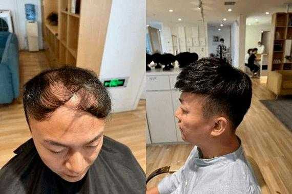 为什么男人老了头顶会秃,男人为什么会秃顶的原因