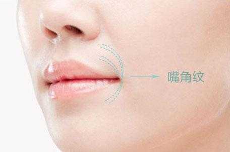 怎么去除嘴角皱纹（怎么去除嘴角皱纹最有效）