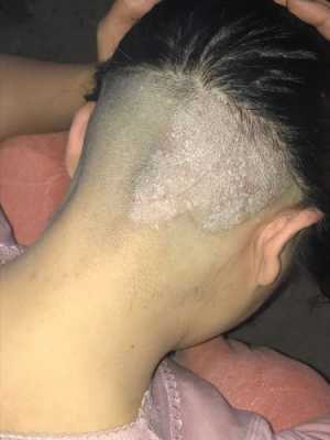 头部痒是怎么回事,头皮痒痒是什么原因引起的
