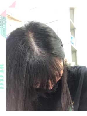 头发越来越稀怎么办（刘海的头发越来越稀怎么办）
