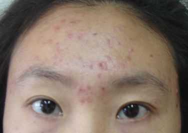 脸上为什么粉刺（脸上为什么粉刺不断的长）