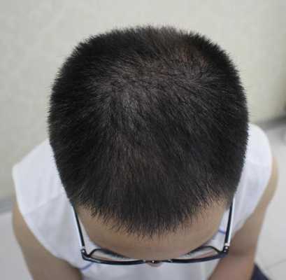 头发稀少怎么改善,头发稀少怎么解决方法