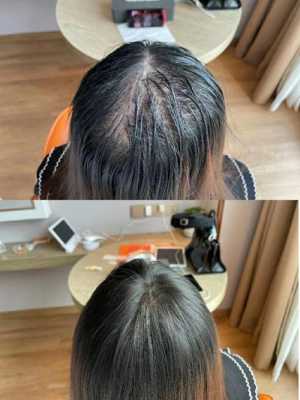 头发稀少怎么改善,头发稀少怎么解决方法