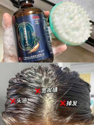 头皮油脱发怎么治疗,油性脱发怎么治疗效果好