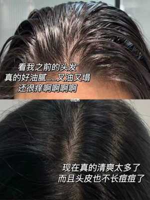 小孩头发油怎么办（16岁男生头发老出油怎么办）