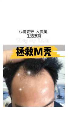 m发际线头顶头发稀少怎么剪,头发稀疏怎么治疗最有效