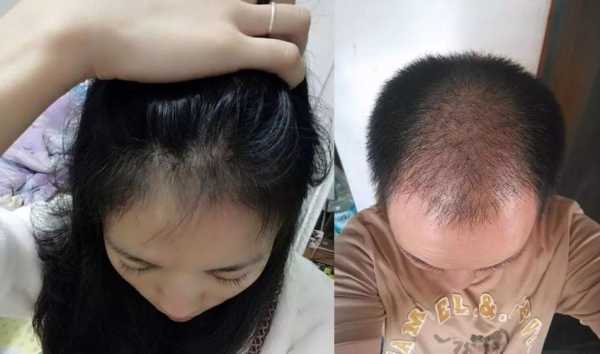m发际线头顶头发稀少怎么剪,头发稀疏怎么治疗最有效