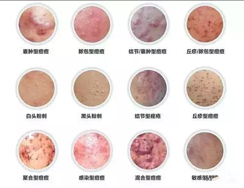 脸上蝇子屎怎么去除,脸上暗疮怎么去除要多长时间