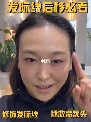 怎么让发际线后移（怎么让发际线后移一点）