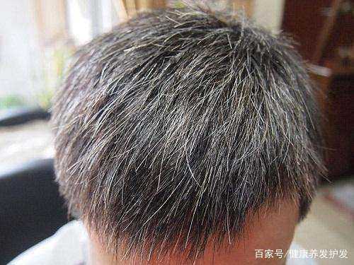 为什么会生白头发（为什么会生白头发的原因）