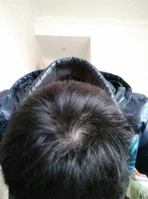 头发稀少该怎么办（手瘾过度导致头发稀少该怎么办）