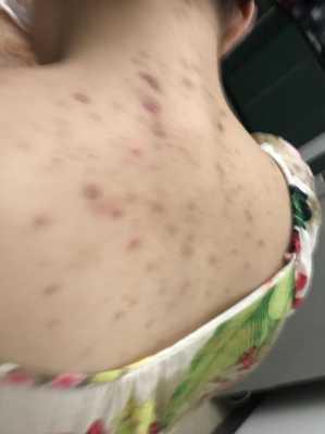 后背有痘痘是什么原因（背部长痘痘怎么回事）