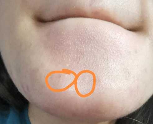 下巴毛孔堵塞怎么办（下巴毛孔堵塞怎么办小妙招）