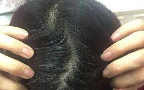 头发变白怎么治（头发怎么变白最快最简单）