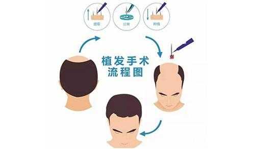 种头发是什么（种头发是什么原理）