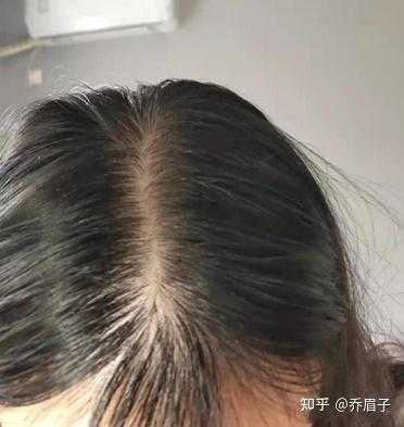脱发厉害是怎么回事（脱发厉害是怎么回事女性）