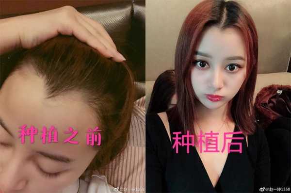 发际线后移了怎么办（发际线后移了怎么办能恢复吗）
