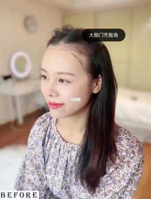 发际线后移了怎么办（发际线后移了怎么办能恢复吗）