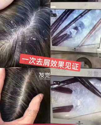 头发痒有头皮屑怎么办（头发痒有头皮屑怎么办小窍门）