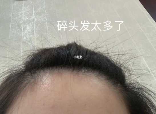 碎头发多是什么原因（碎头发太多怎么办）