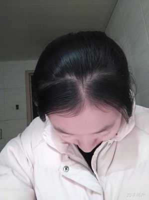 碎头发多是什么原因（碎头发太多怎么办）