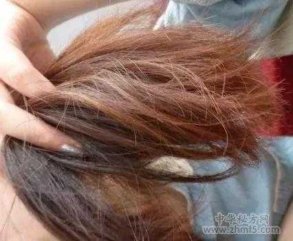 掉头发掉的厉害怎么办（掉头发掉的厉害怎么办有什么偏方吗）