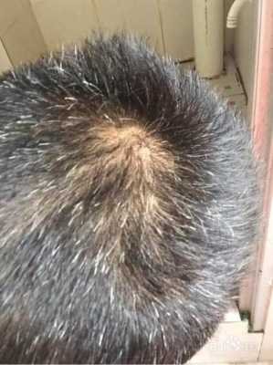 头发发白怎么回事（头发发白怎么回事缺什么）