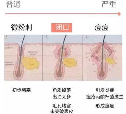 皮肤闭口是什么意思（闭口的形成原因和解决方法）
