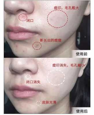 皮肤闭口是什么意思（闭口的形成原因和解决方法）