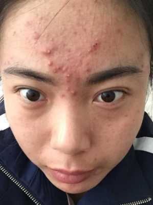 怎么才能去青春痘（怎么才能去青春痘）