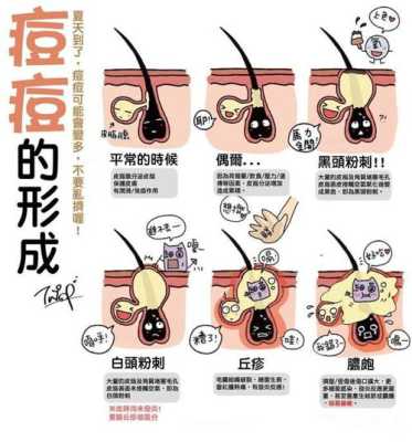 怎么才能去青春痘（怎么才能去青春痘）