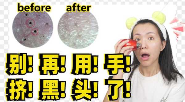 去黑头有什么好办法（去黑头有什么好办法吗）