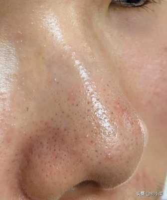 鼻头黑头怎么去除,鼻头很多黑头怎么办图片