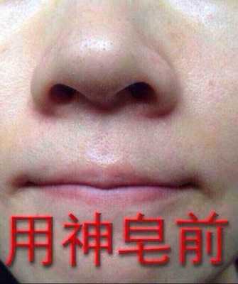 鼻头黑头怎么去除,鼻头很多黑头怎么办图片